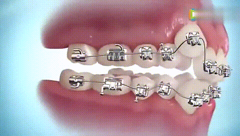 温馨小贴士:        传统牙套是如何矫正牙齿的?